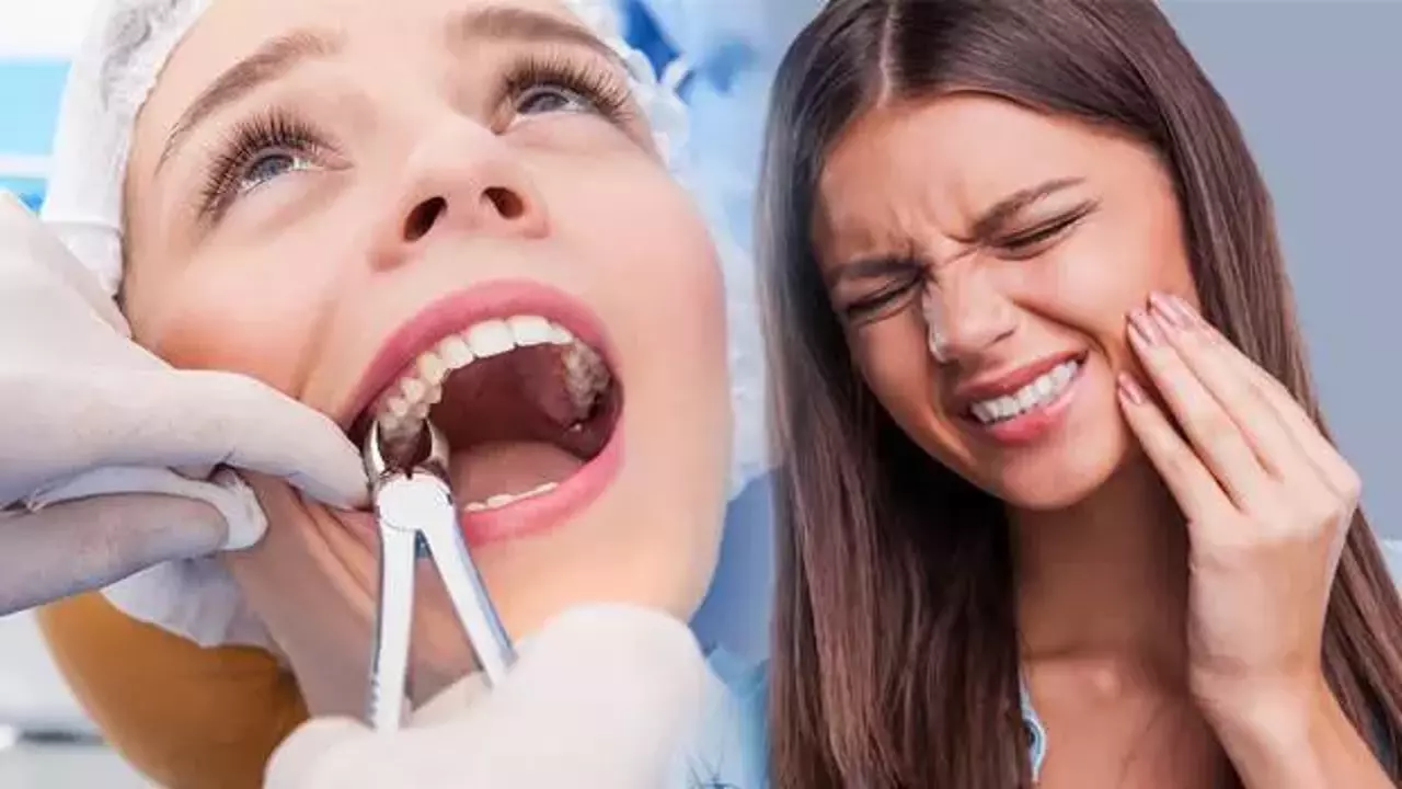 20 yaş diş çekimi fiyatı ne kadar, nerede çektirilir?
