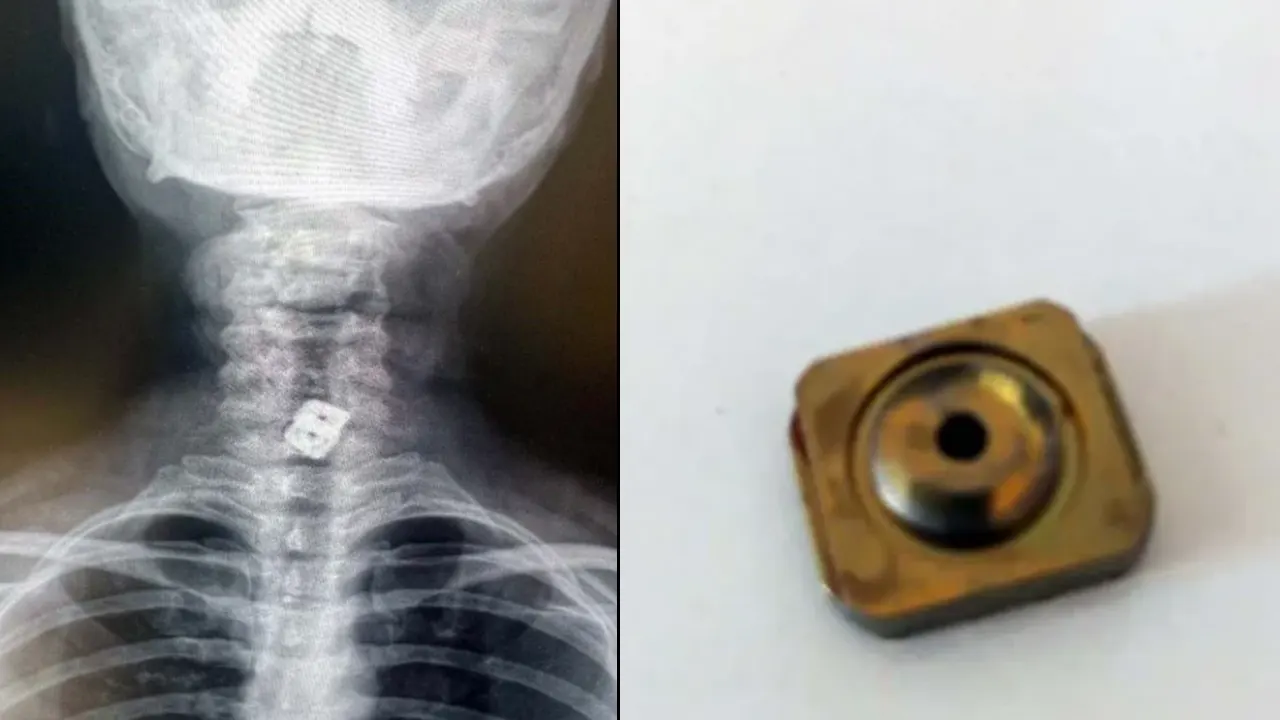 Tıp literatüründe eşi benzeri görülmedi: Boyun fıtığı için takılan implant bakın neresine düştü