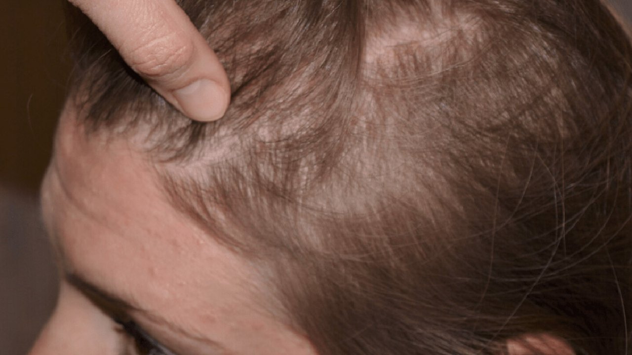 Kellik ve saç dökülmesine karşı etkili yöntem: Bu doğal yağlar saç köklerini güçlendiriyor