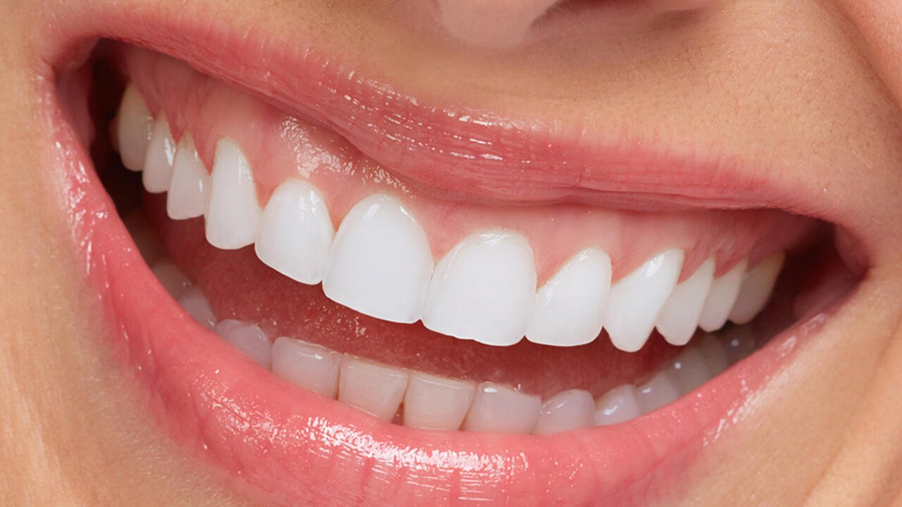 2023 diş beyazlatma güncel fiyatları, devlette ve özelde diş beyazlatma kaç TL?