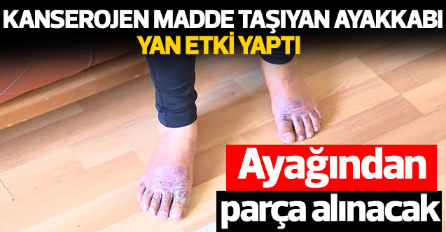 Ayaklarında yara oluşan Gonca Gül'den "kimyasal ayakkabı" şikayeti